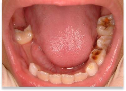 口腔内の状況　下顎
